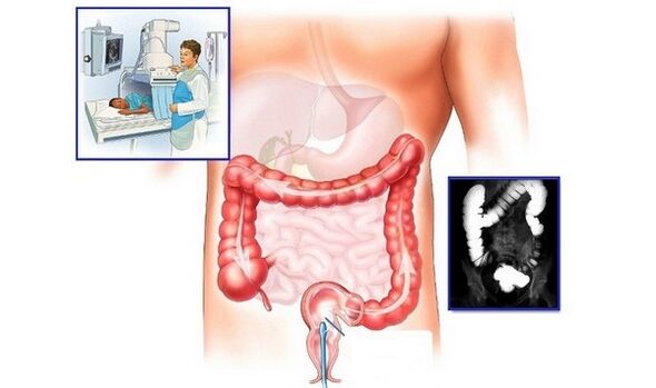 Radiografía do intestino groso con contraste para o diagnóstico de hemorroides